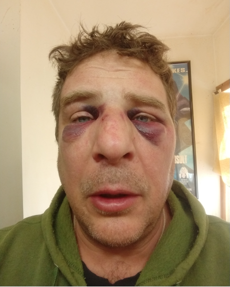 Nose broken & Sinus Cavity Crushed.